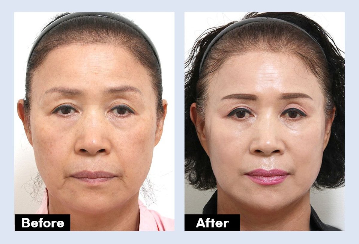 Resultados antes y después de lifting endoscópico facial en URBAN Plastic Surgery, rejuvenecimiento