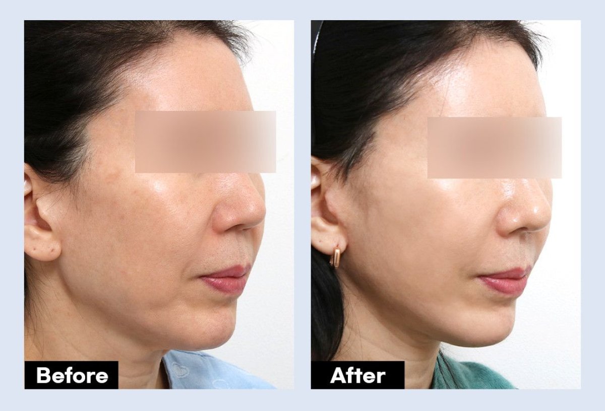 Efekty endoskopowego liftingu twarzy przed i po w URBAN Plastic Surgery, odmłodzenie