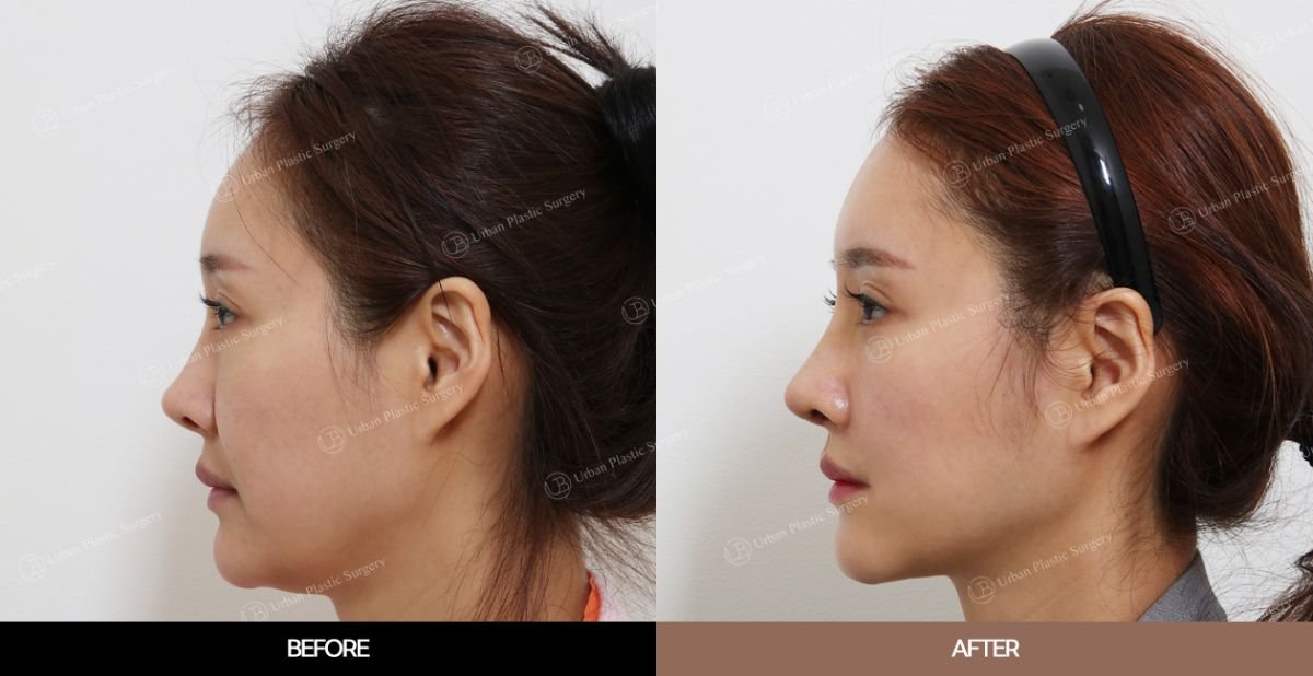 Before and after endoscopic facelift results at URBAN Plastic Surgery, facial contour improvement