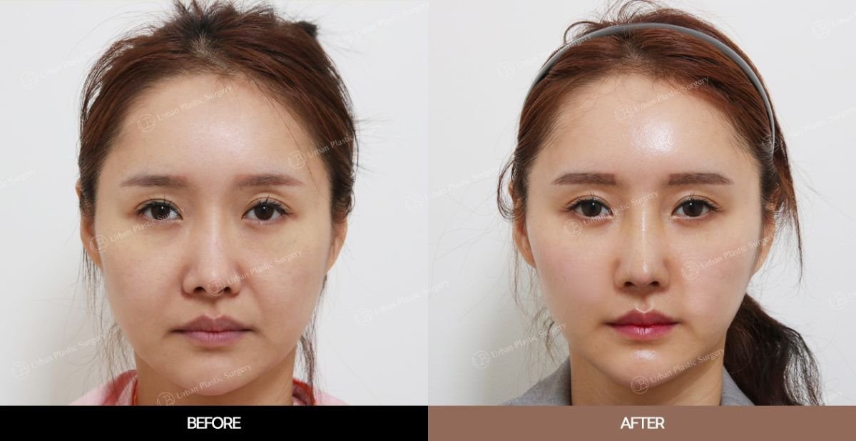 Before and after endoscopic facelift results at URBAN Plastic Surgery, facial rejuvenation