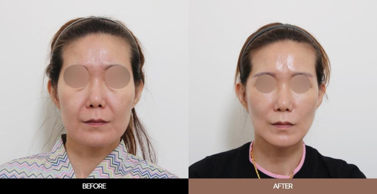 Результати ендоскопічної підтяжки обличчя до і після в URBAN Plastic Surgery, омолодження