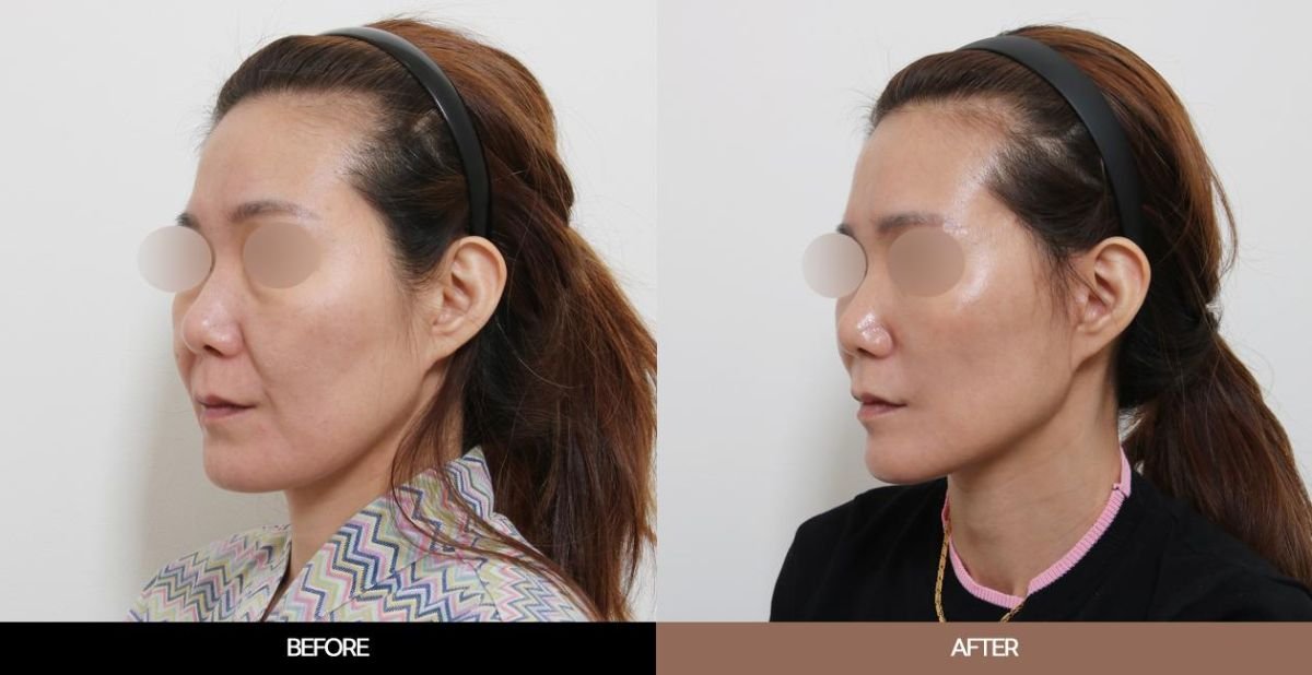 Vorher-nachher-Ergebnisse Endoskopisches Facelifting bei URBAN Plastic Surgery, Verjüngung