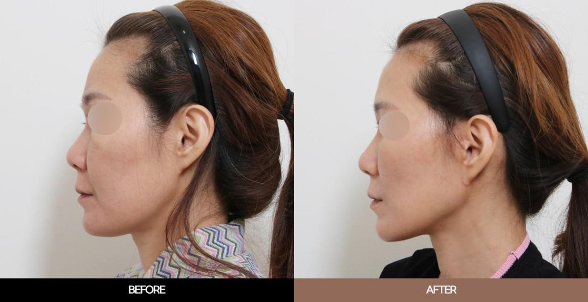 Результати до і після ендоскопічної підтяжки обличчя в URBAN Plastic Surgery, омолодження