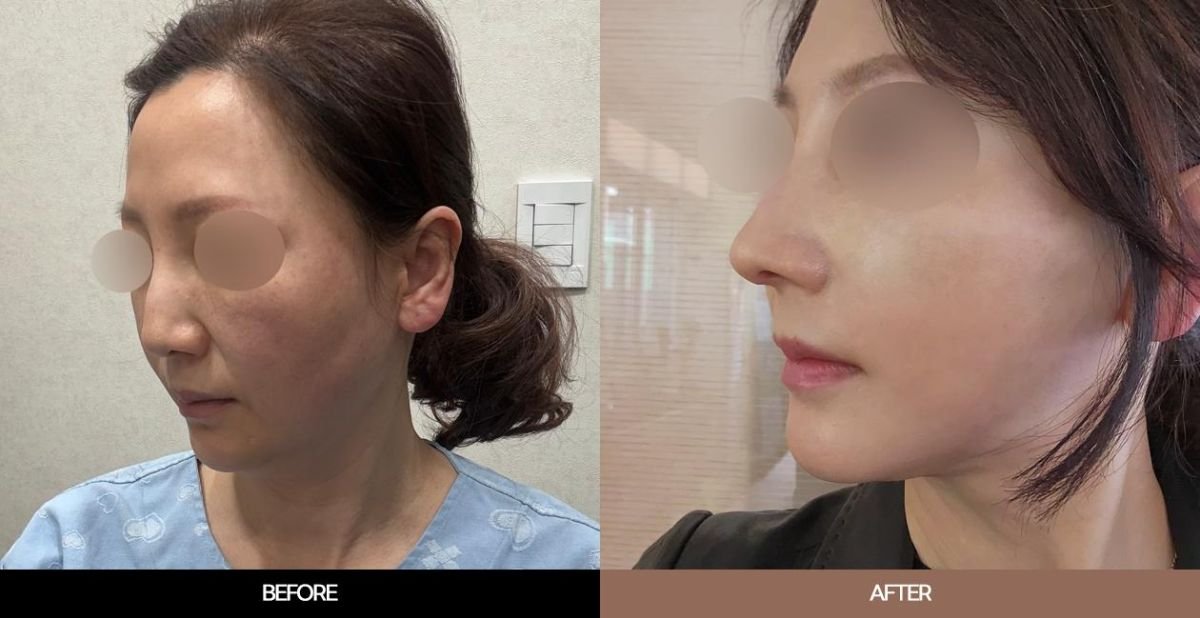 Resultados de lifting endoscópico facial antes y después en URBAN Plastic Surgery, rejuvenecimiento