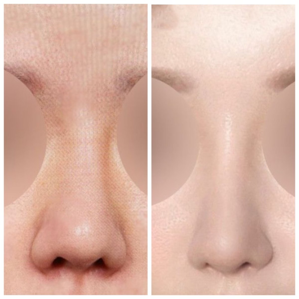 Resultados antes y después de alarplastia en URBAN Plastic Surgery, mejora de la forma nasal