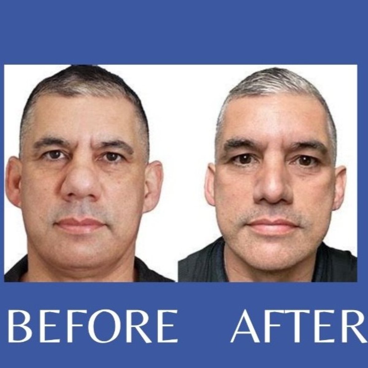 Before and after tip rhinoplasty results at ID Clinic Bangkok, improved nose shape visible