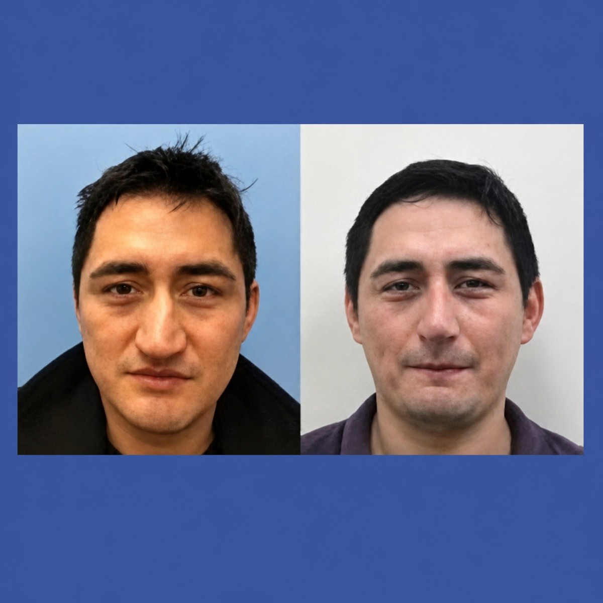 Before and after tip rhinoplasty results at ID Clinic Bangkok, improved nose shape visible