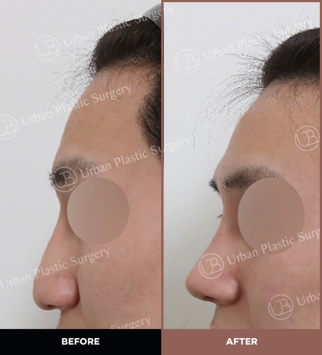 Before and after ultrasonic rhinoplasty results at URBAN Plastic Surgery, improved nose profile