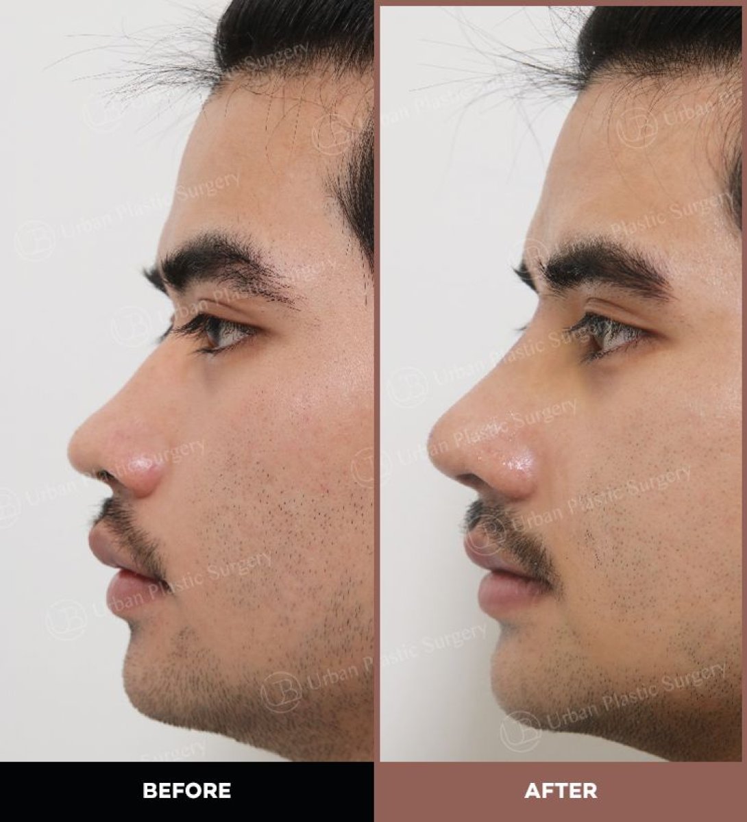 Before and after ultrasonic rhinoplasty results at URBAN Plastic Surgery, improved nose profile