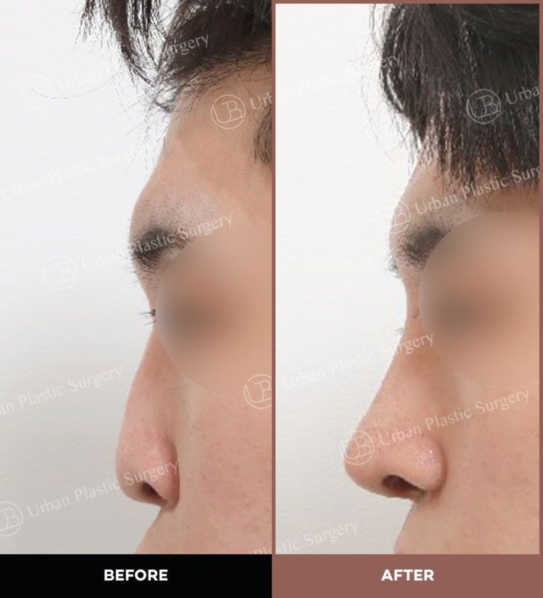 Efekt przed i po ultradźwiękowej korekcji nosa w URBAN Plastic Surgery, poprawiony profil nosa