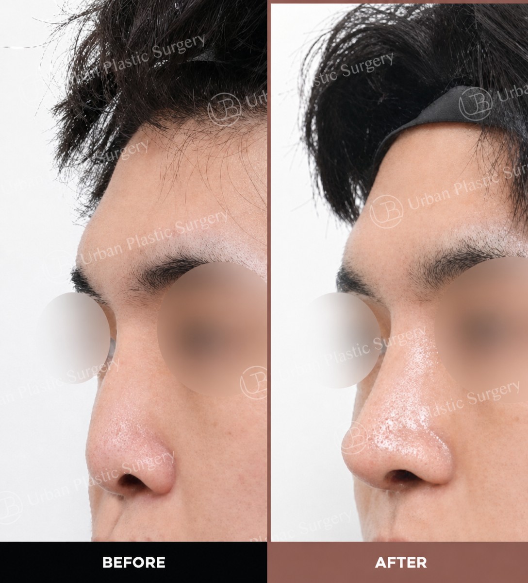 نتائج قبل وبعد تجميل الأنف بالموجات فوق الصوتية في URBAN Plastic Surgery، تحسين شكل الأنف