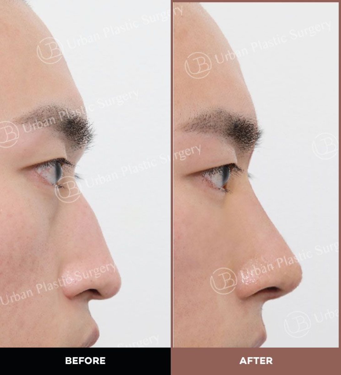 Before and after ultrasonic rhinoplasty results at URBAN Plastic Surgery, nose reshaping