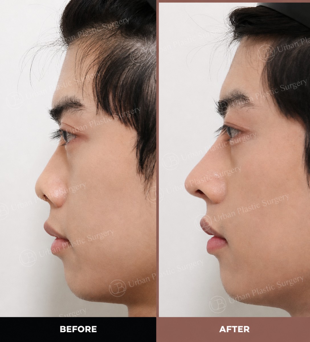 Результаты до и после ультразвуковой ринопластики в URBAN Plastic Surgery, изящная форма носа
