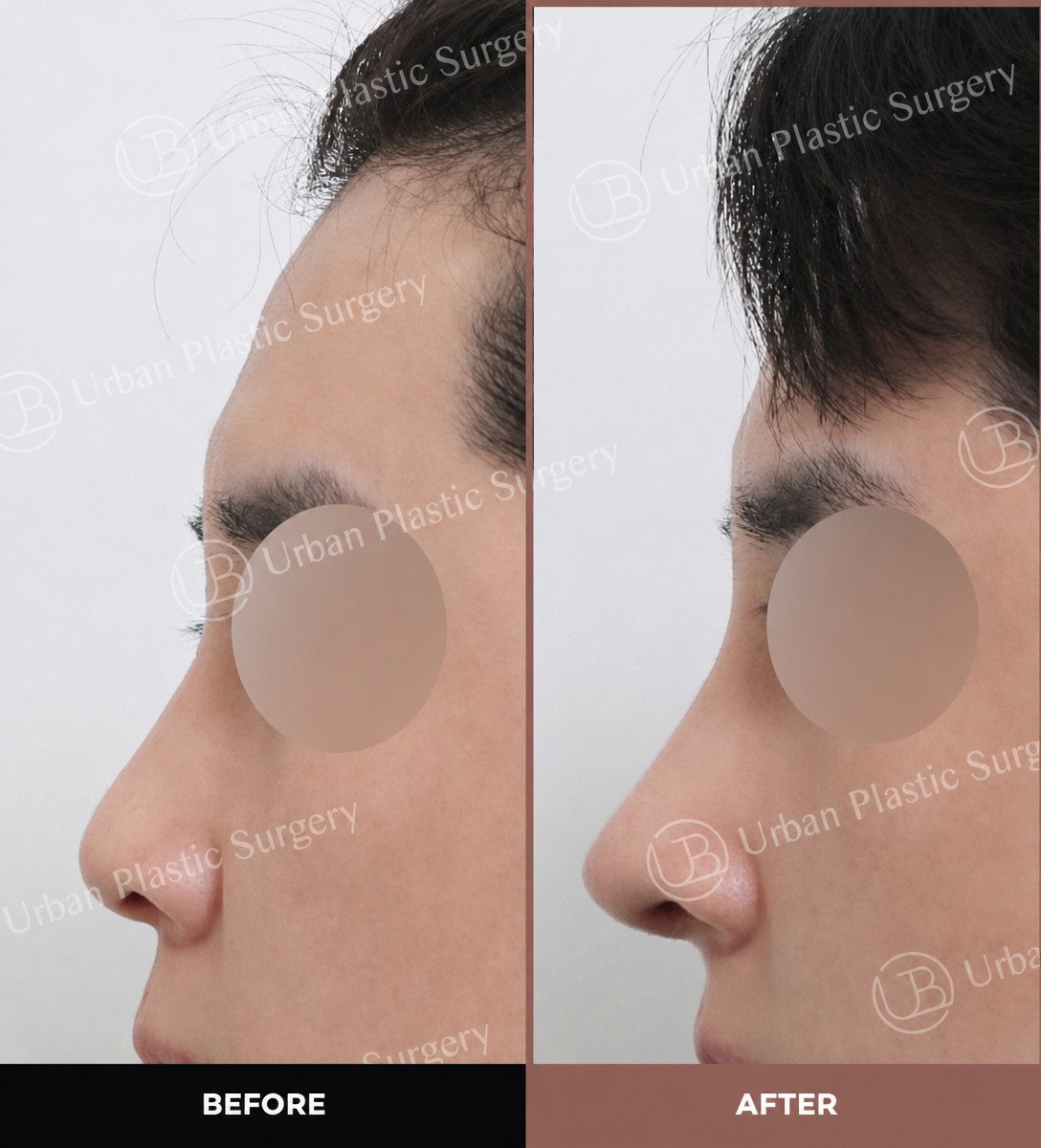 نتائج قبل وبعد تجميل الأنف بالموجات فوق الصوتية في URBAN Plastic Surgery، إعادة تشكيل الأنف