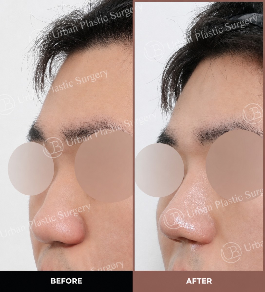 Before and after ultrasonic rhinoplasty results at URBAN Plastic Surgery, improved nose shape