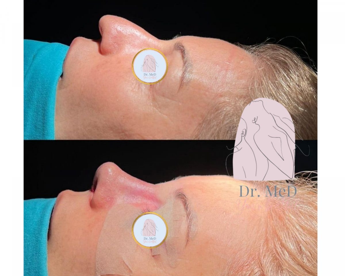 نتائج قبل وبعد عملية تصحيح الحاجز الأنفي في Dr. MED، تحسين شكل الأنف
