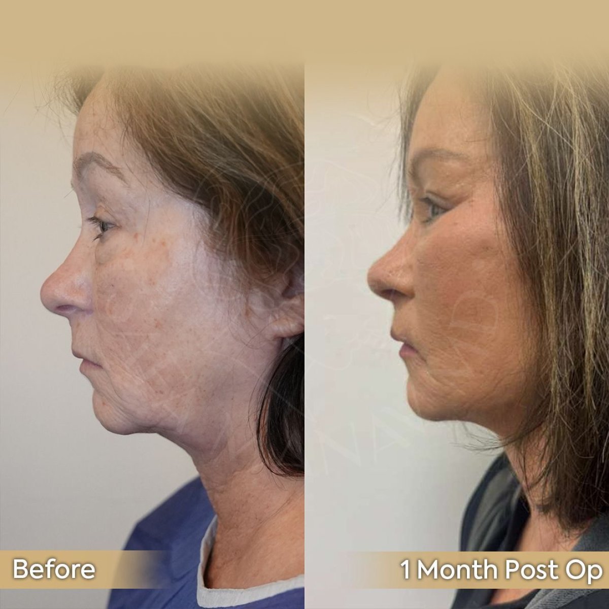 Resultados de lifting de cuello antes y después en Dr. Safa Manav Clinic, mejora visible de la mandíbula