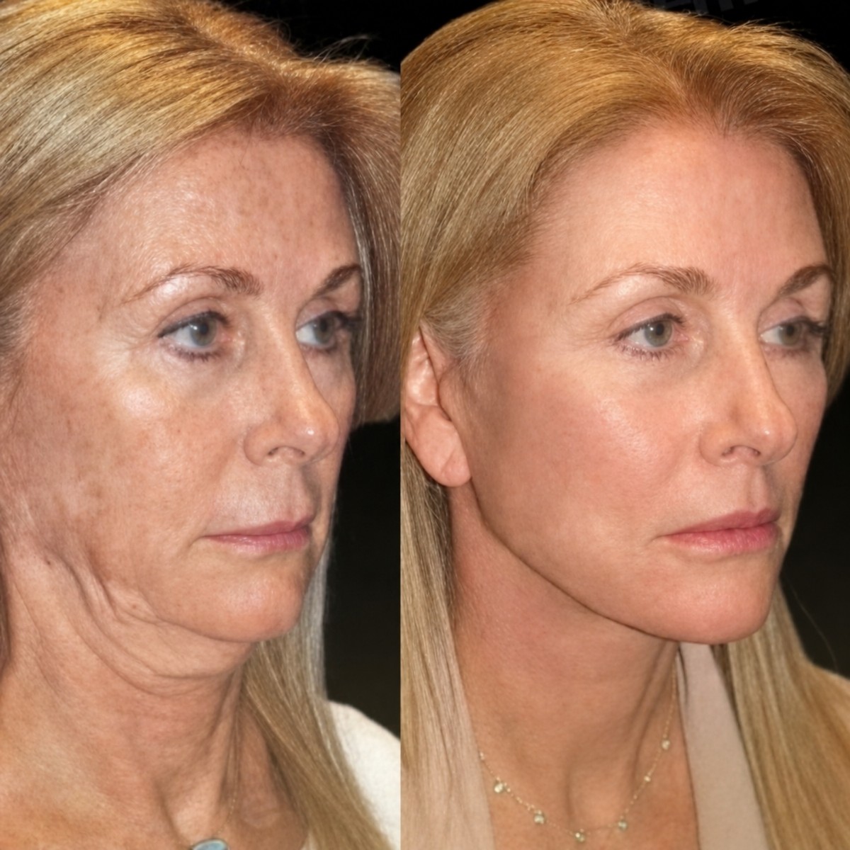 Before and after mini facelift results at Memorial Bahçelievler Hospital, facial rejuvenation