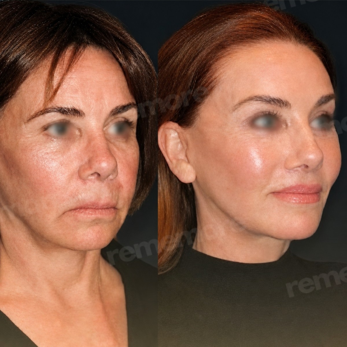 Résultats avant/après mini lifting au Memorial Bahçelievler Hospital, rajeunissement du visage