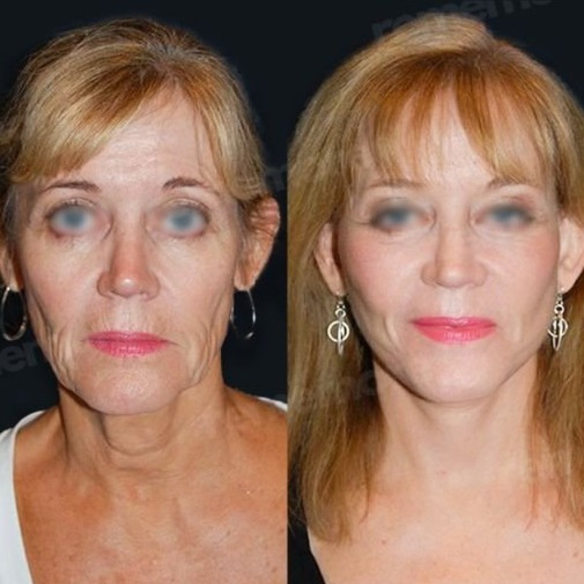 Resultados de minilifting facial antes y después en Memorial Bahçelievler Hospital, rejuvenecimiento