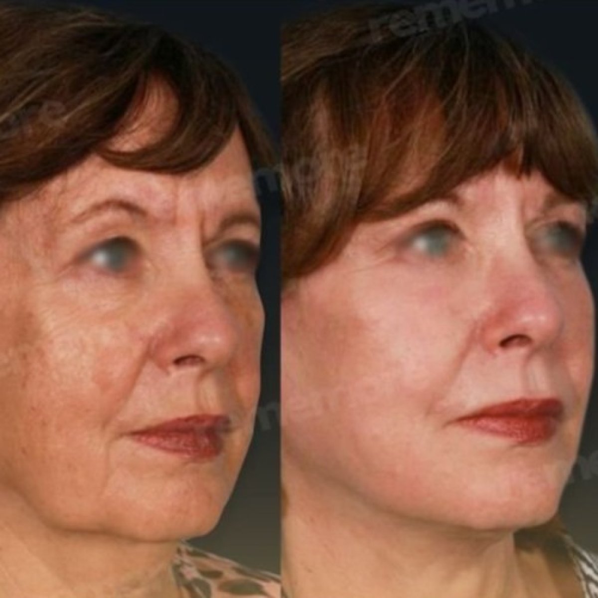 Resultados de minilifting facial antes y después en Memorial Bahçelievler Hospital, rejuvenecimiento