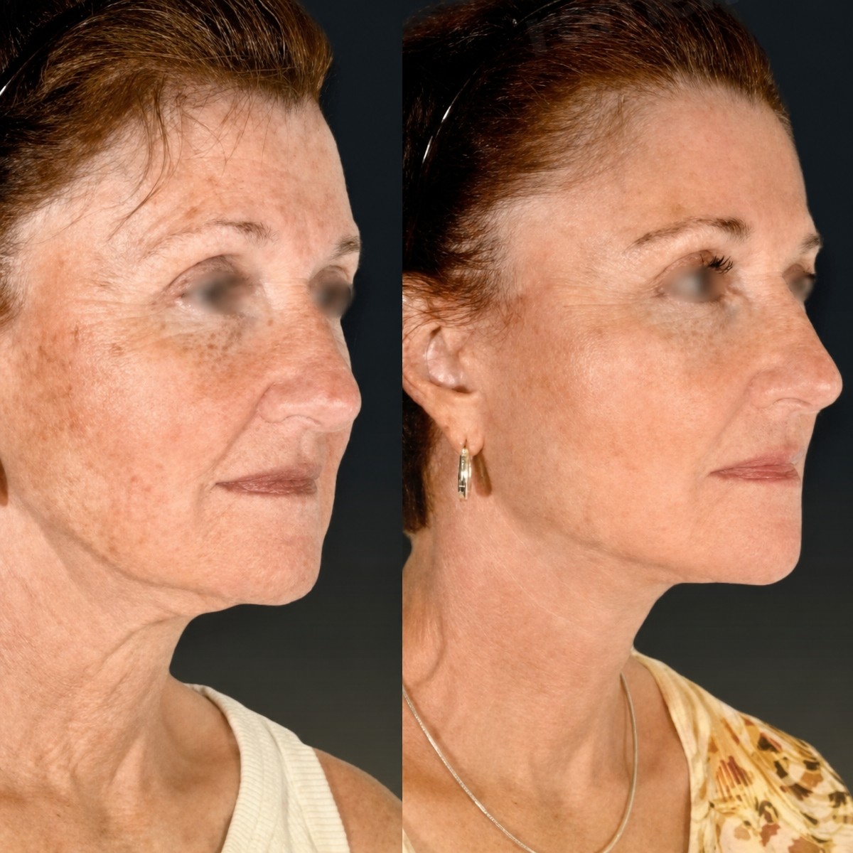 Before and after mini facelift results at Memorial Bahçelievler Hospital, facial rejuvenation