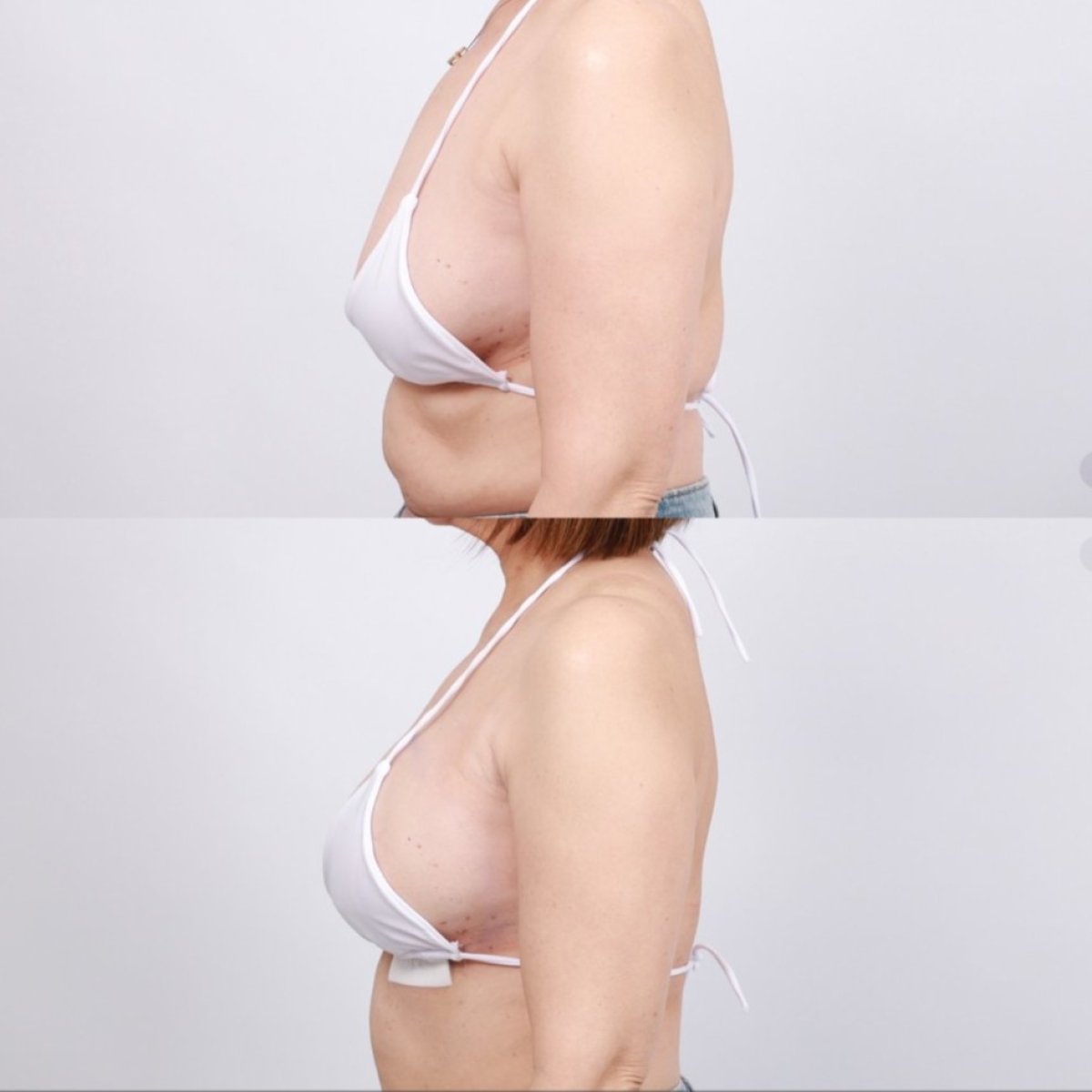 نتائج شد الثدي قبل وبعد في Dr. Chen Surgery Hospital International Center، تحسين الشكل