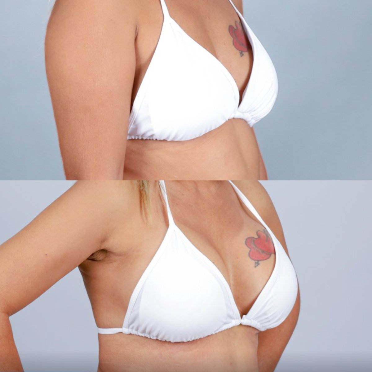 Resultados antes y después de lifting de senos en Dr. Chen Surgery Hospital International Center