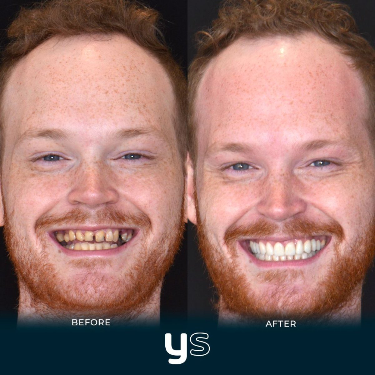 Результаты до и после установки циркониевого моста в YeahSmile – улучшение улыбки
