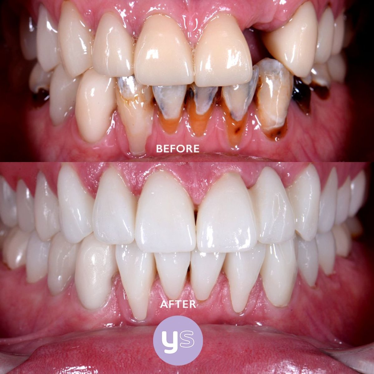 Resultados antes y después de puente dental de zirconia en YeahSmile – sonrisa restaurada