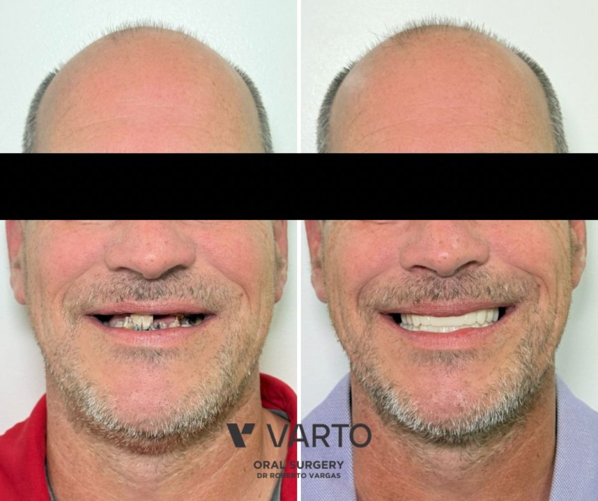 Результат до и после установки имплантов All-on-6 в клинике Varto Oral Surgery