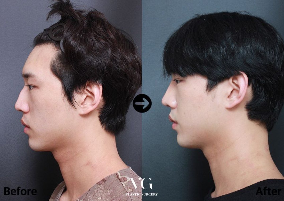 نتائج تجميل الأنف بالموجات فوق الصوتية قبل وبعد في VG Plastic Surgery، تحسين شكل الأنف