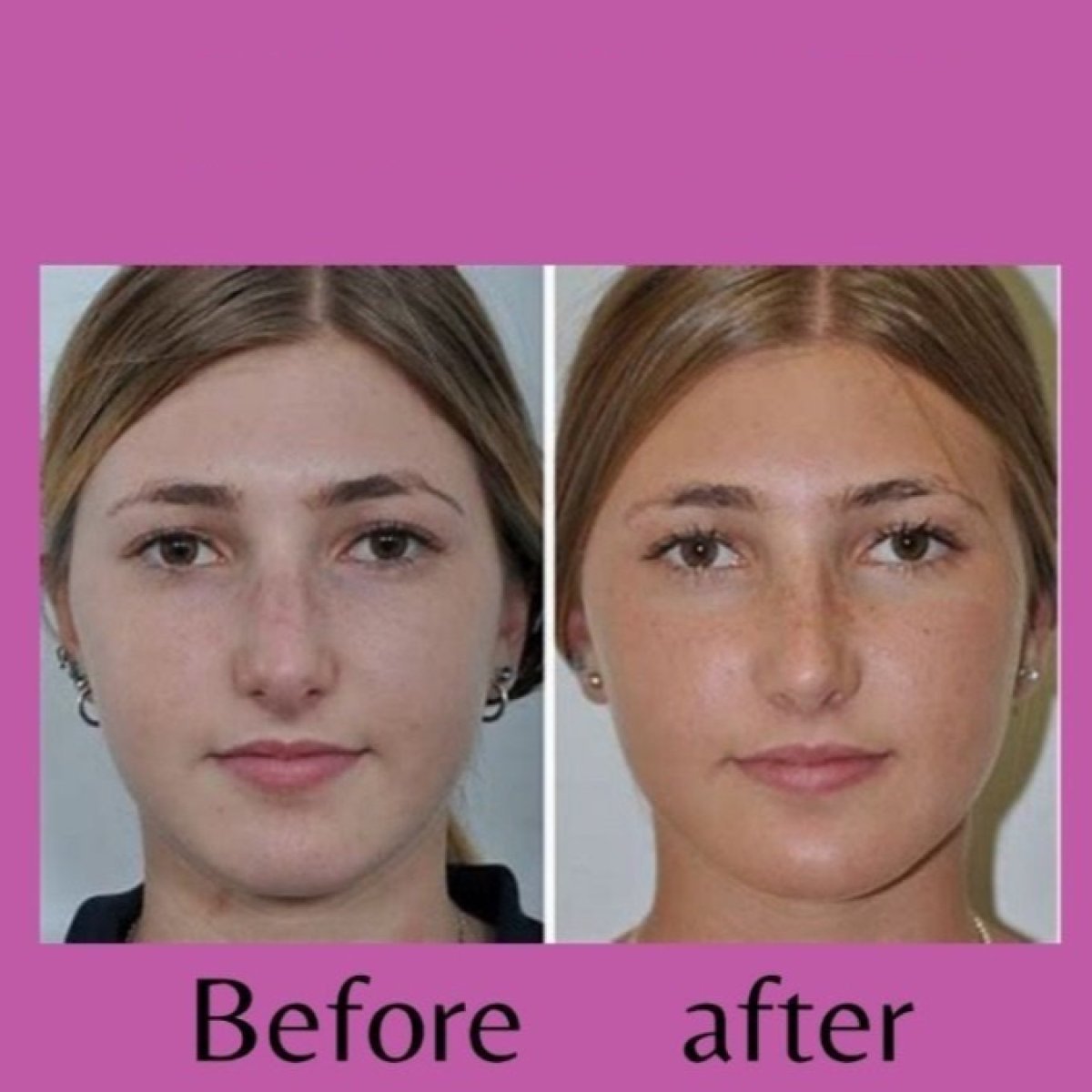 Before and after tip rhinoplasty results at ID Clinic Bangkok, refined nose shape visible