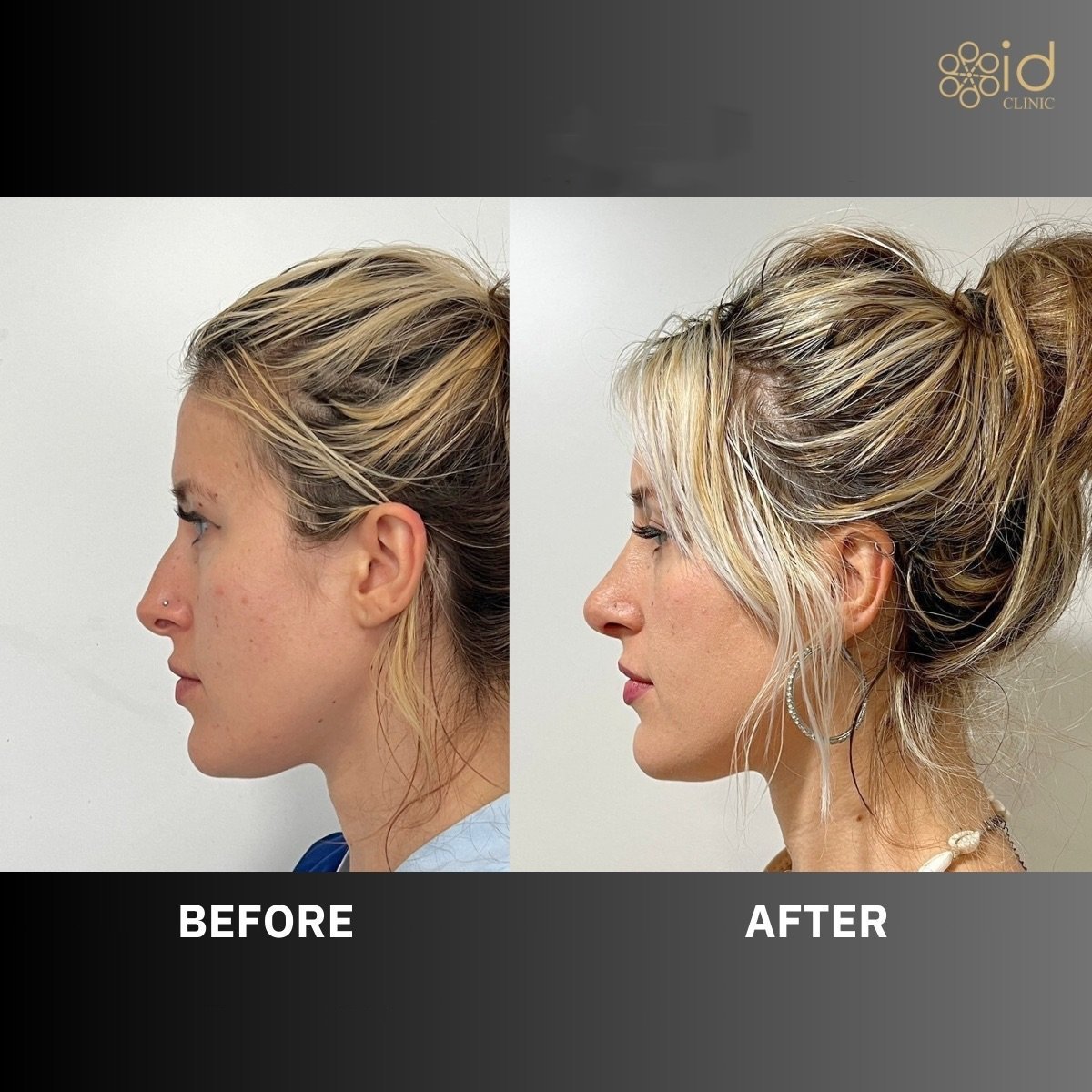 Before and after tip rhinoplasty results at ID Clinic Bangkok, nose reshaping improvement