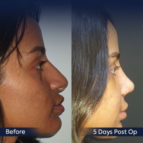 Premium Rhinoplasty (nose job) All Included - photo 4