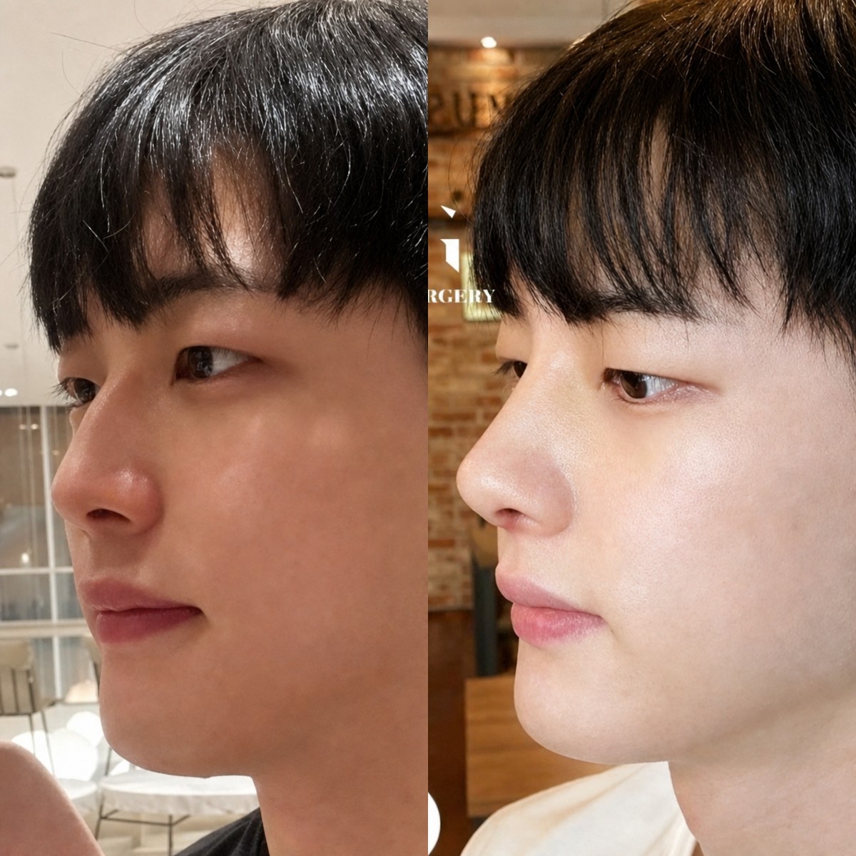 Результати до і після ультразвукової ринопластики у VG Plastic Surgery, покращена форма носа