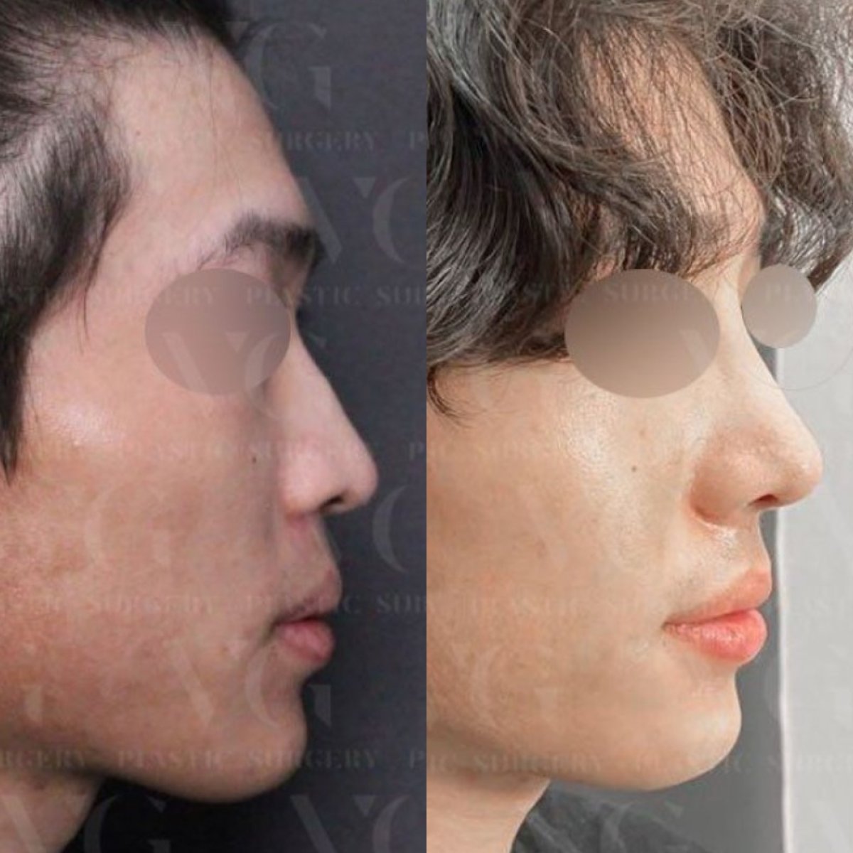 نتائج قبل وبعد تجميل الأنف بالموجات فوق الصوتية في VG Plastic Surgery، تحسين شكل الأنف