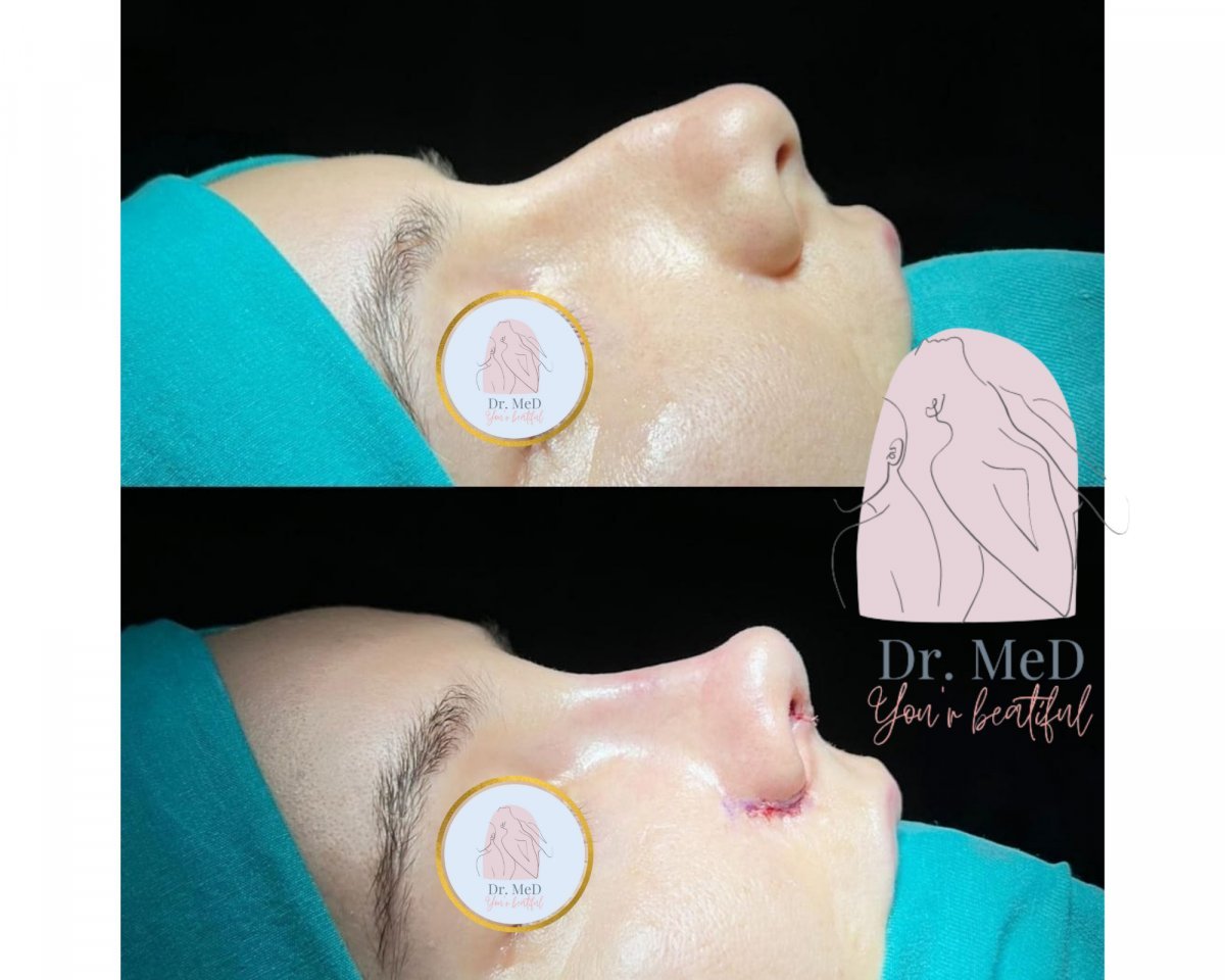 Resultados de rinoplastia antes y después en Dr. MED, perfil nasal mejorado