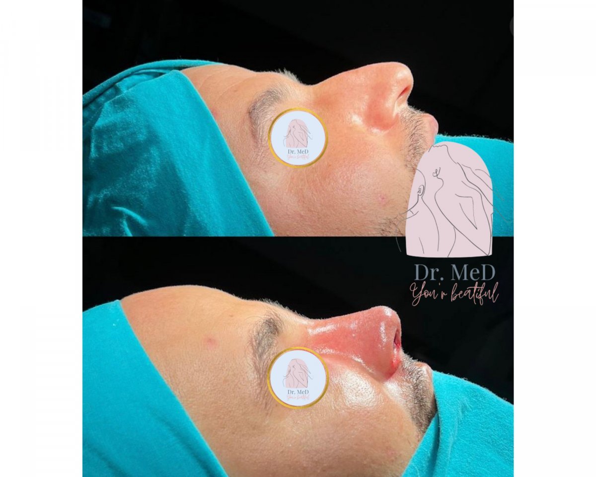 Before and after rhinoplasty results at Dr. MED, improved nose shape and profile