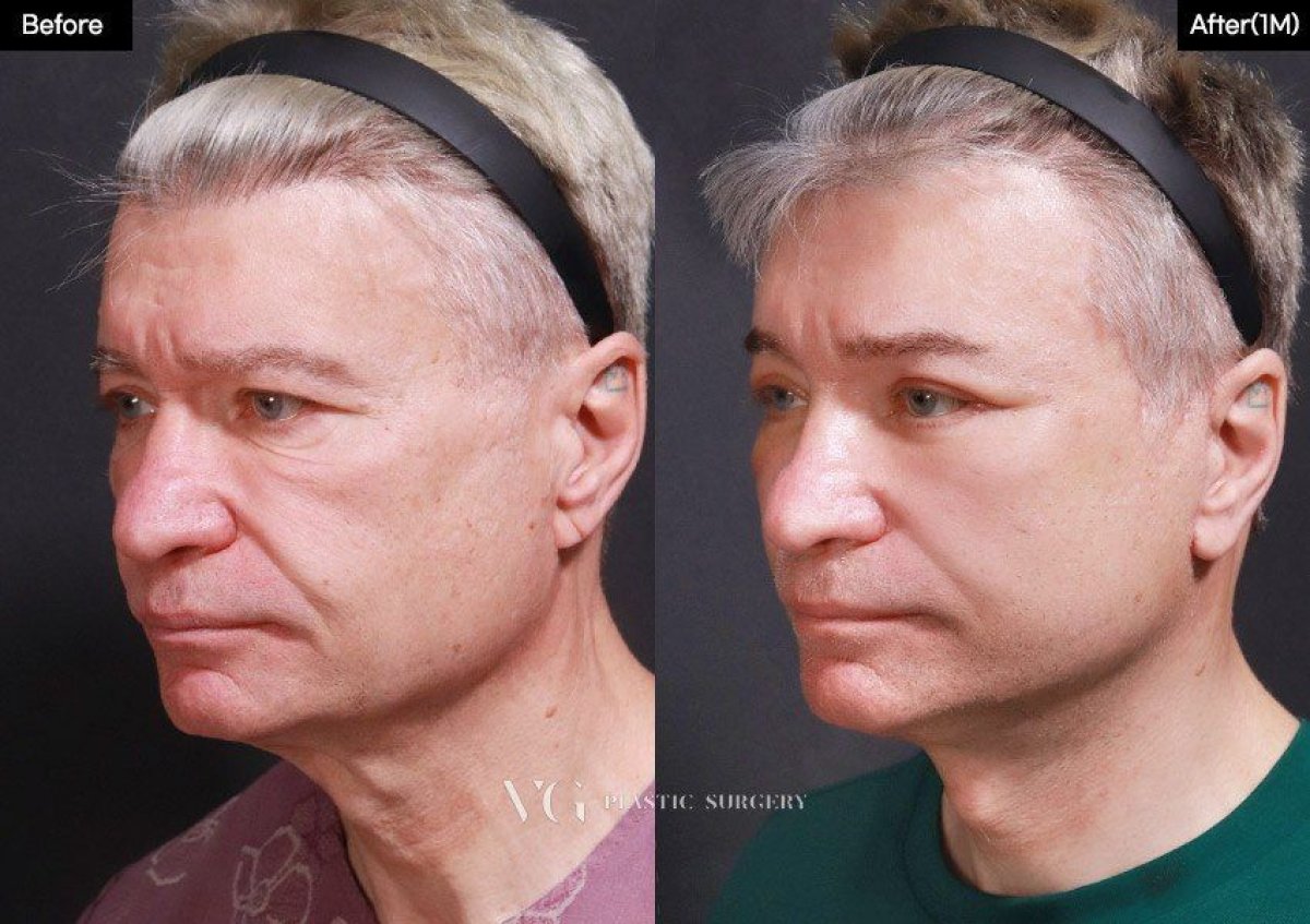 Результати до і після deep plane SMAS-ліфтингу у VG Plastic Surgery, омолодження обличчя