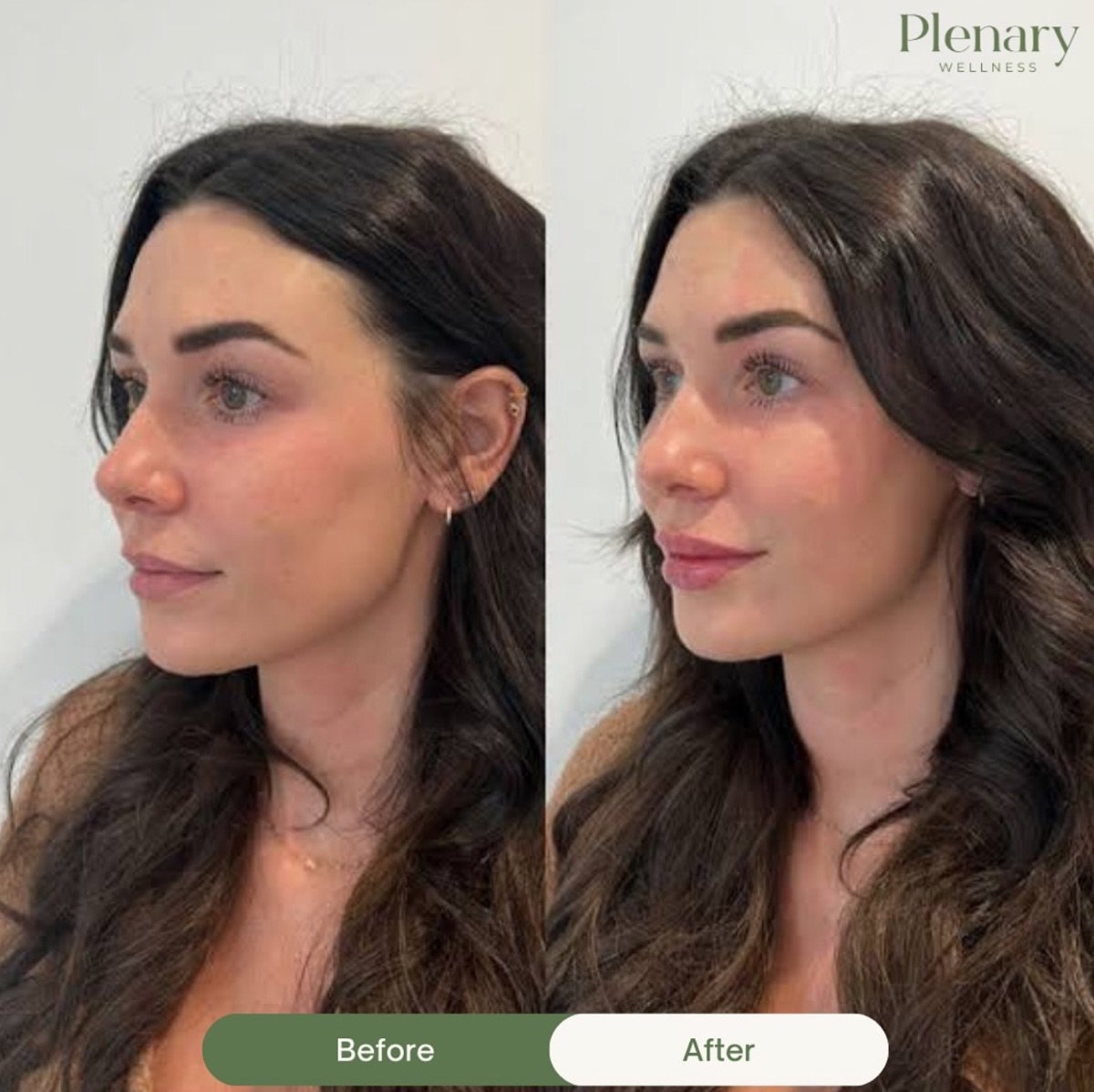 Before and after lip lift results at Plenary Wellness, enhanced lip contour and youthful look