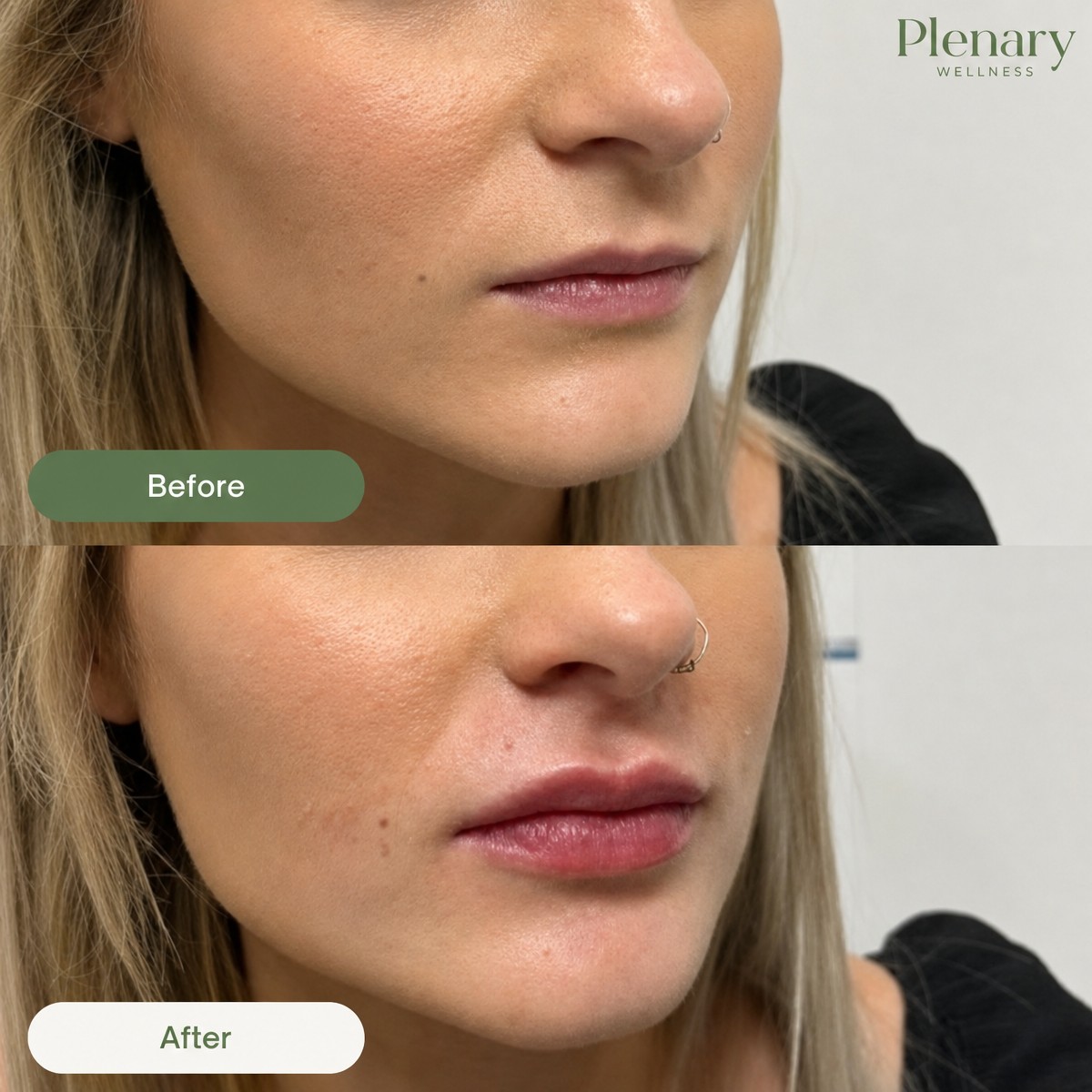 Resultados de lifting de labios antes y después en Plenary Wellness, mayor contorno y volumen