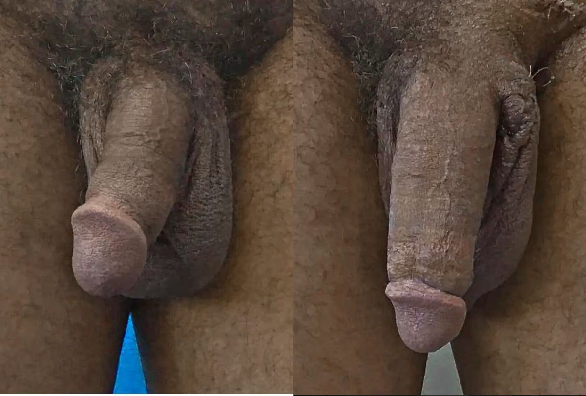 Before and after penis enlargement results at Uroaesthetic clinic, visible size improvement