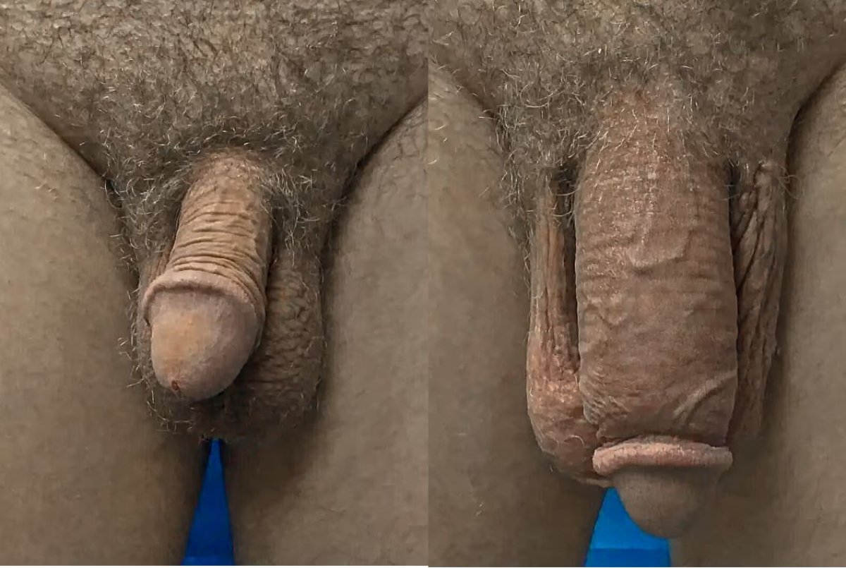 Resultados antes y después de aumento de pene en Uroaesthetic, mejora visible del tamaño