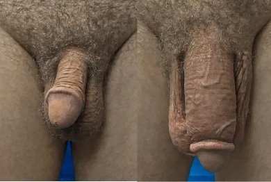 Penis Enlargement Surgery by USA & Germany-Trained Urologist — 900+ Cases, 4★ Hotel & Transfer - photo 4