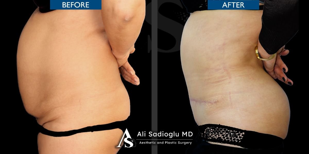 Before and after tummy tuck results at Dr. Safa Manav Clinic, improved abdominal contour