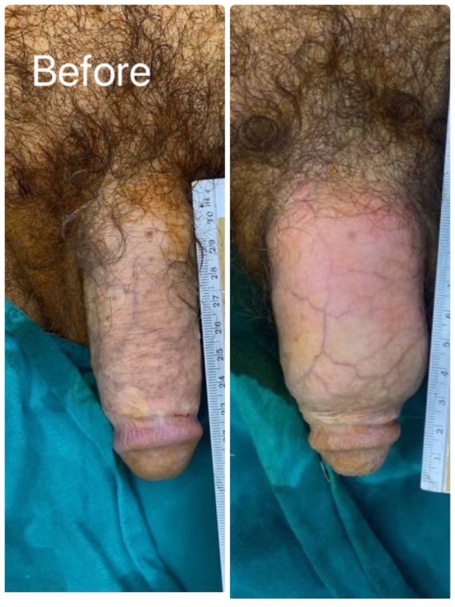 Before and after Genital PRP (O-Shot) results at ID Clinic Bangkok, visible enhancement shown