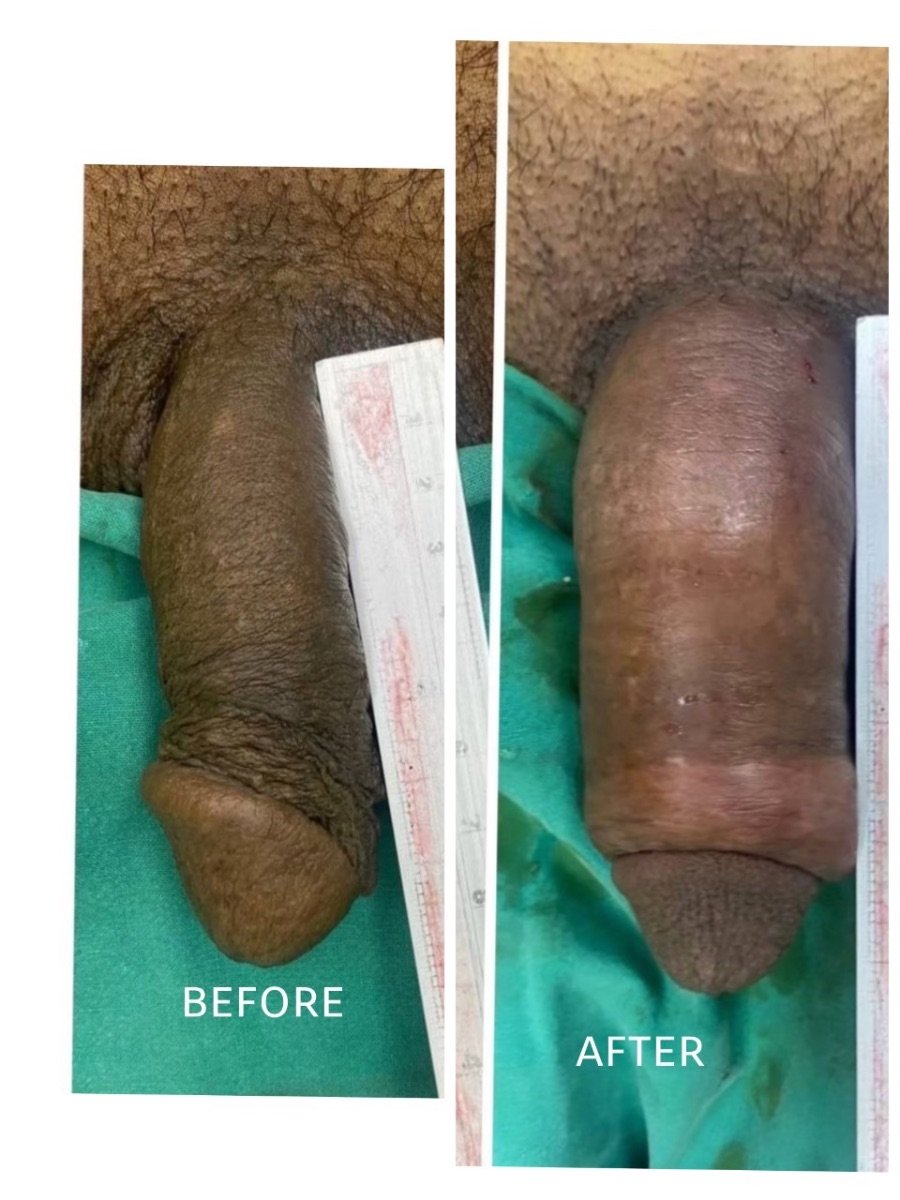 Before and after Genital PRP (O-Shot) results at ID Clinic Bangkok, visible enhancement