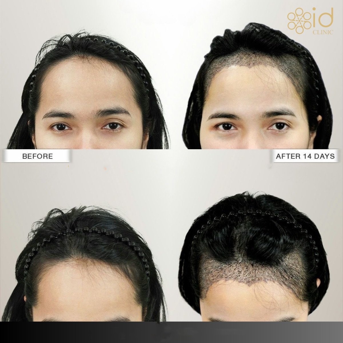 Before and after FUE hair transplant at ID Clinic Bangkok, visible hairline restoration result