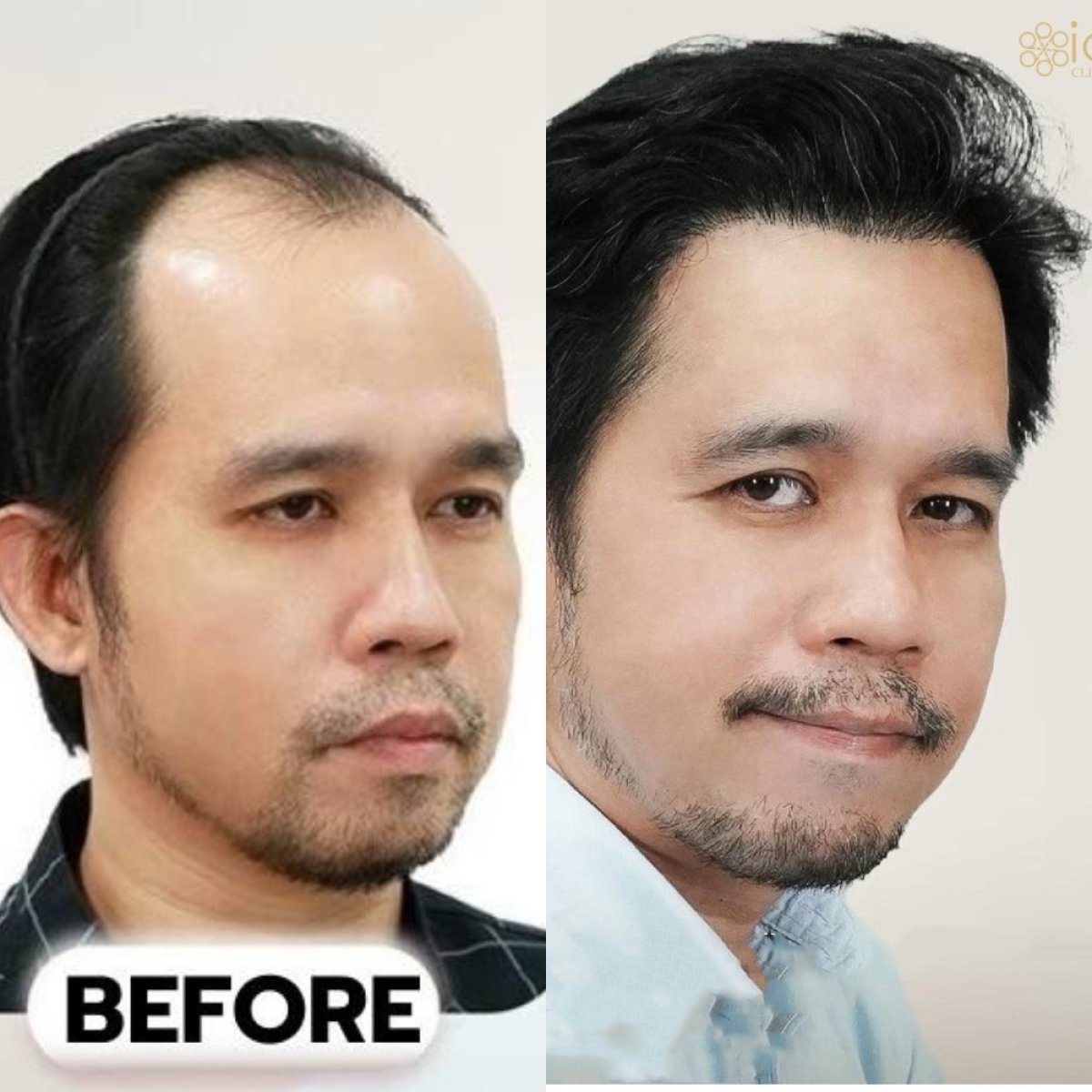 Before and after FUE hair transplant result at ID Clinic Bangkok, restored fuller hairline